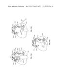 DIAPHRAGM ENTRY FOR POSTERIOR SURGICAL ACCESS diagram and image