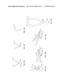 DIAPHRAGM ENTRY FOR POSTERIOR SURGICAL ACCESS diagram and image