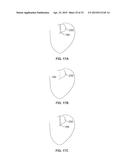 DIAPHRAGM ENTRY FOR POSTERIOR SURGICAL ACCESS diagram and image