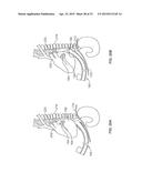 DIAPHRAGM ENTRY FOR POSTERIOR SURGICAL ACCESS diagram and image