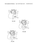 DIAPHRAGM ENTRY FOR POSTERIOR SURGICAL ACCESS diagram and image