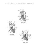 SYSTEMS AND METHODS FOR MONITORING ENDOLUMINAL VALVE FORMATION diagram and image