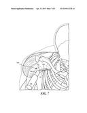 Systems and Methods for Needle for Subclavian Vein Penetration diagram and image