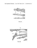 DEVICES FOR BONE FIXATION USING AN INTRAMEDULLARY FIXATION IMPLANT diagram and image