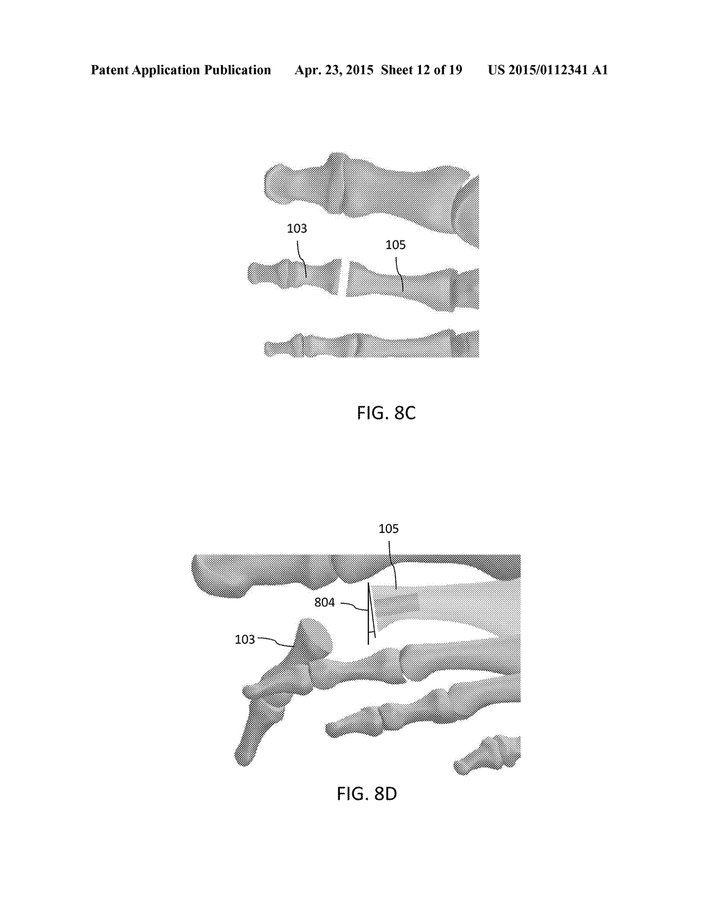 DEVICES FOR BONE FIXATION USING AN INTRAMEDULLARY FIXATION IMPLANT - diagram, schematic, and image 13