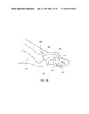 METHODS FOR BONE FIXATION USING AN INTRAMEDULLARY FIXATION IMPLANT diagram and image