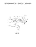 METHODS FOR BONE FIXATION USING AN INTRAMEDULLARY FIXATION IMPLANT diagram and image