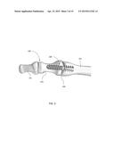 METHODS FOR BONE FIXATION USING AN INTRAMEDULLARY FIXATION IMPLANT diagram and image