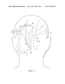 IMPLANTABLE HEAD MOUNTED NEUROSTIMULATION SYSTEM FOR HEAD PAIN diagram and image