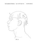 IMPLANTABLE HEAD MOUNTED NEUROSTIMULATION SYSTEM FOR HEAD PAIN diagram and image