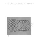 HEART VALVE PROSTHESIS WITH OPEN STENT diagram and image