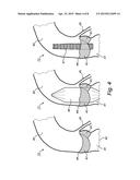 PRE-OPERATIVE SIMULATION OF TRANS-CATHETER VALVE IMPLANTATION diagram and image