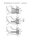 PRE-OPERATIVE SIMULATION OF TRANS-CATHETER VALVE IMPLANTATION diagram and image