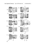 PRE-OPERATIVE SIMULATION OF TRANS-CATHETER VALVE IMPLANTATION diagram and image