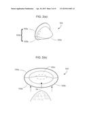 DENTAL APPLIANCE diagram and image