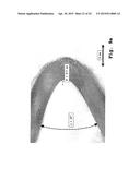 Osteosynthesis with nano-silver diagram and image