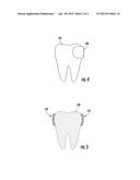 TITANIUM AND TITANIUM ALLOYS FOR A DENTAL MATRIX BAND diagram and image