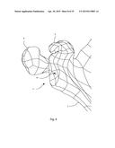 GLENOID ARTHROPLASTY AND OFFSET REAMERS diagram and image