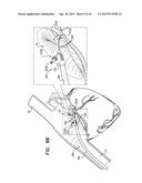 PERCUTANEOUS TETHER LOCKING diagram and image