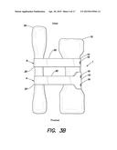 SURGICAL IMPLANT FOR CORRECTION OF HALLUX VALGUS OR TAILOR S BUNION diagram and image