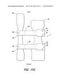 SURGICAL IMPLANT FOR CORRECTION OF HALLUX VALGUS OR TAILOR S BUNION diagram and image