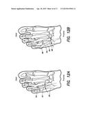 SURGICAL IMPLANT FOR CORRECTION OF HALLUX VALGUS OR TAILOR S BUNION diagram and image