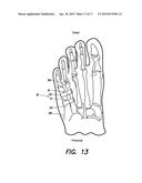 SURGICAL IMPLANT FOR CORRECTION OF HALLUX VALGUS OR TAILOR S BUNION diagram and image