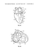 SYSTEMS AND METHODS FOR TRANSCATHETER TREATMENT OF VALVE REGURGITATION diagram and image