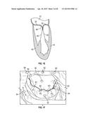 SYSTEMS AND METHODS FOR TRANSCATHETER TREATMENT OF VALVE REGURGITATION diagram and image