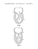 SYSTEMS AND METHODS FOR TRANSCATHETER TREATMENT OF VALVE REGURGITATION diagram and image