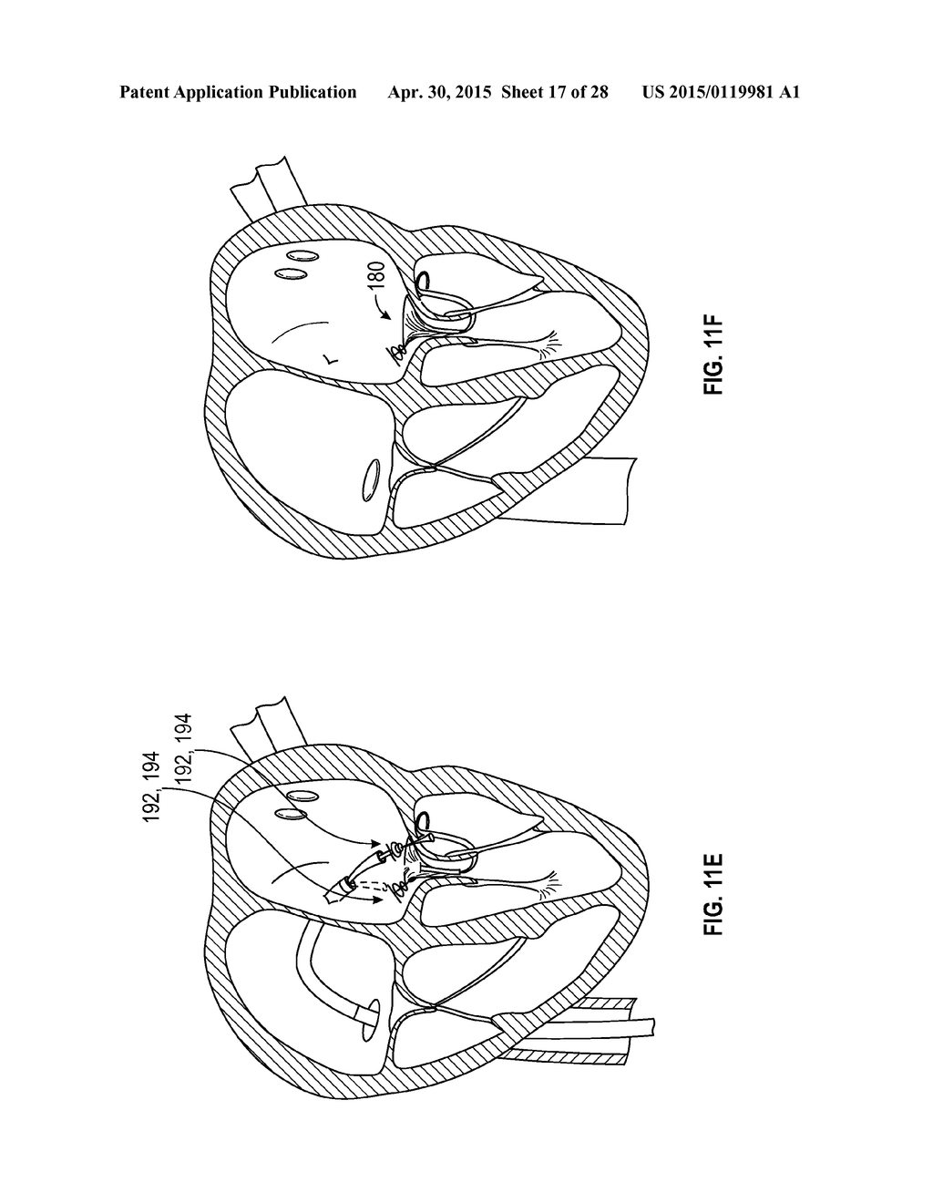 SYSTEMS AND METHODS FOR TRANSCATHETER TREATMENT OF VALVE REGURGITATION - diagram, schematic, and image 18