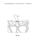 SYSTEMS AND METHODS FOR TRANSCATHETER TREATMENT OF VALVE REGURGITATION diagram and image