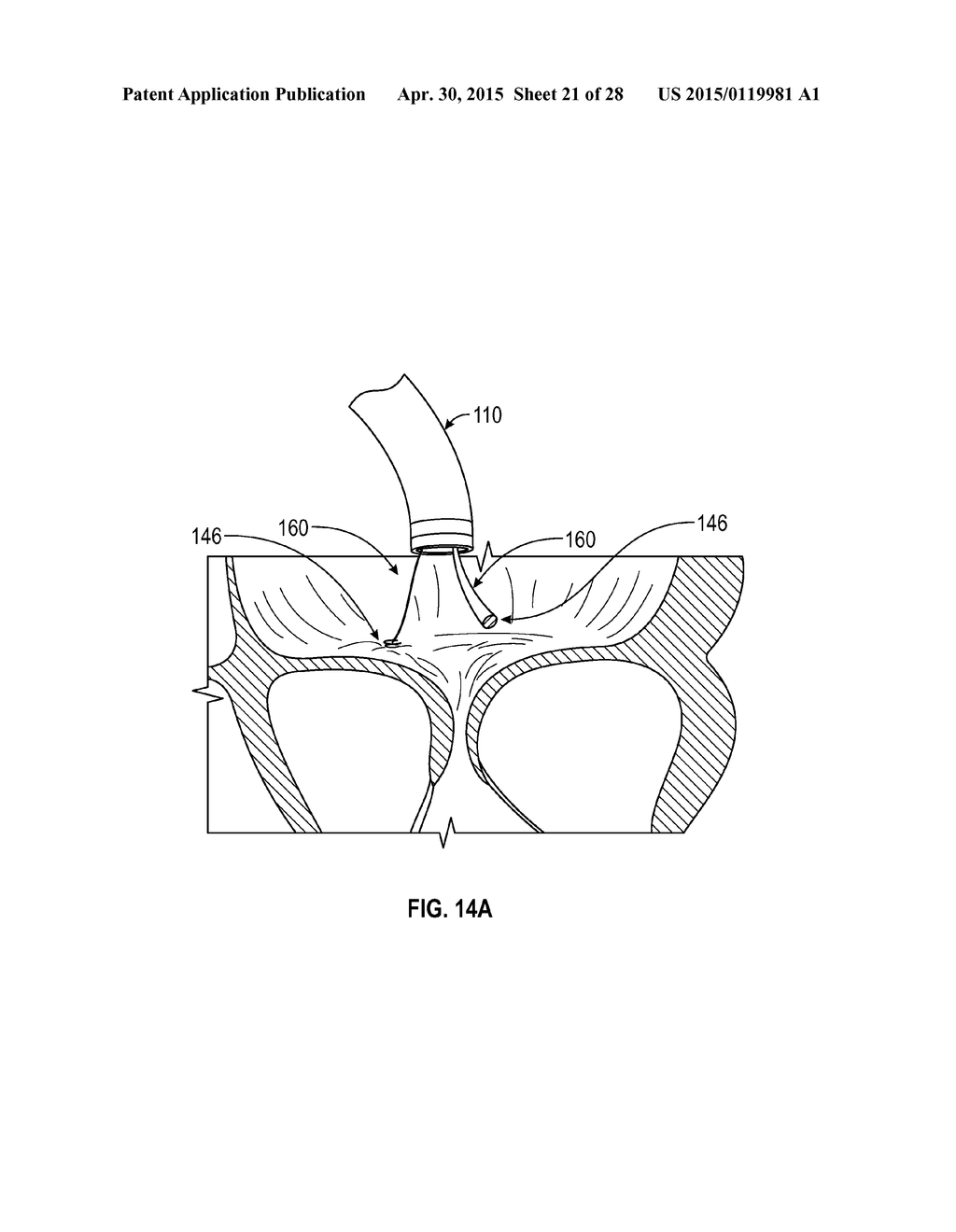 SYSTEMS AND METHODS FOR TRANSCATHETER TREATMENT OF VALVE REGURGITATION - diagram, schematic, and image 22