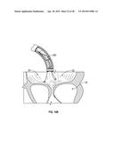 SYSTEMS AND METHODS FOR TRANSCATHETER TREATMENT OF VALVE REGURGITATION diagram and image