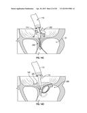 SYSTEMS AND METHODS FOR TRANSCATHETER TREATMENT OF VALVE REGURGITATION diagram and image