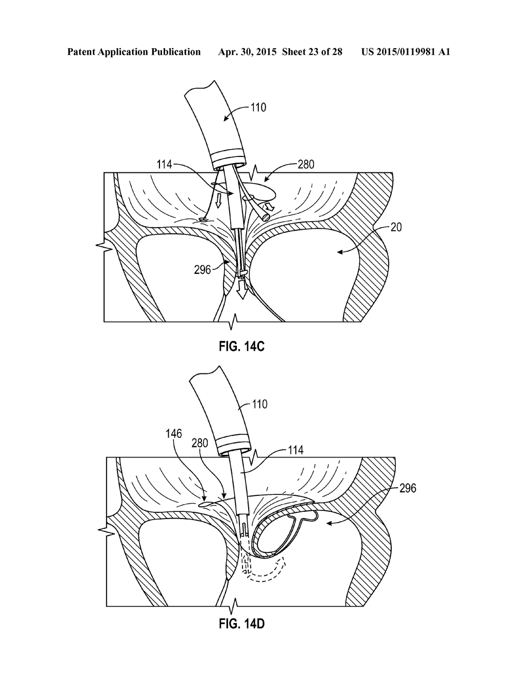 SYSTEMS AND METHODS FOR TRANSCATHETER TREATMENT OF VALVE REGURGITATION - diagram, schematic, and image 24