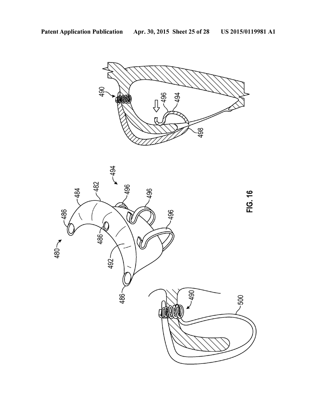 SYSTEMS AND METHODS FOR TRANSCATHETER TREATMENT OF VALVE REGURGITATION - diagram, schematic, and image 26