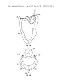 SYSTEMS AND METHODS FOR TRANSCATHETER TREATMENT OF VALVE REGURGITATION diagram and image