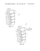 INTERVERTEBRAL DISC PROSTHESIS AND METHOD diagram and image