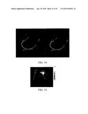 METHOD OF GENERATING A PATIENT-SPECIFIC BONE SHELL diagram and image