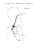 METHODS AND APPARATUS FOR TRANSESOPHAGEAL MICROACCESS SURGERY diagram and image