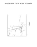 RETROGRADE ENTRY ANTEGRADE PLACEMENT FOR FEMORAL ARTERY ACCESS diagram and image