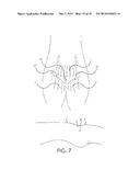 RETROGRADE ENTRY ANTEGRADE PLACEMENT FOR FEMORAL ARTERY ACCESS diagram and image