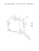 RETROGRADE ENTRY ANTEGRADE PLACEMENT FOR FEMORAL ARTERY ACCESS diagram and image