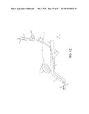 RETROGRADE ENTRY ANTEGRADE PLACEMENT FOR FEMORAL ARTERY ACCESS diagram and image