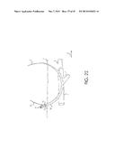 RETROGRADE ENTRY ANTEGRADE PLACEMENT FOR FEMORAL ARTERY ACCESS diagram and image