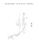 RETROGRADE ENTRY ANTEGRADE PLACEMENT FOR FEMORAL ARTERY ACCESS diagram and image