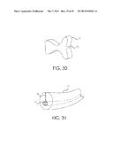 RETROGRADE ENTRY ANTEGRADE PLACEMENT FOR FEMORAL ARTERY ACCESS diagram and image