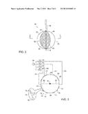 SEGMENTED BALLOON CATHETER diagram and image