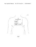 METHOD AND APPARATUS FOR DETECTING ATRIAL FILLING PRESSURE diagram and image